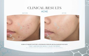 HUIDstudio27 Acne-Clinical-Results 